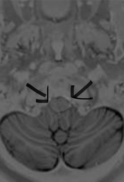 Transtorno do sistema nervoso central em um caso de “labirintite” 10 – Anti- Gad elevado e Nistagmo espontâneo vertical inferior (Spontaneous downbeat nystagmus)